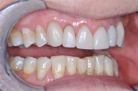 Teeth Grinding — Dentistry In The Ranch