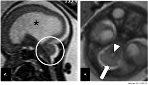 Evaluation Of The Fetal Cerebellum By Magnetic Resonance Imaging