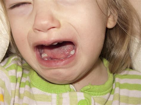 Sores On Tongue And Throat Pics Included Parenting Community