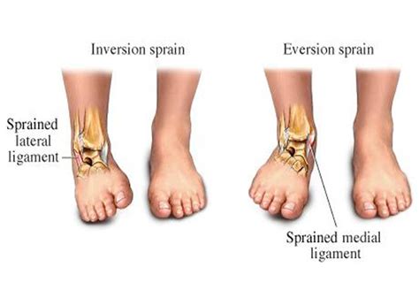 Sprained Ankle Claremore Podiatry