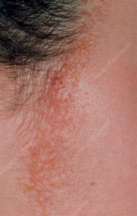 Seborrhoeic Dermatitis Around Hairline Stock Image M1400162