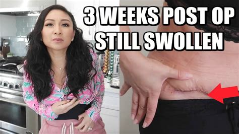 3 Week Tummy Tuck Post Op Update Youtube
