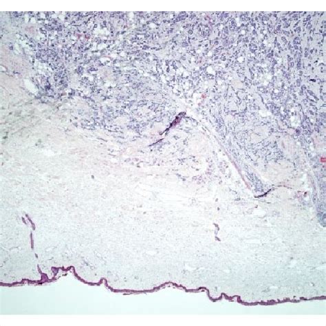 Extent Of Merkel Cell Carcinoma With Epidermis Not Involved