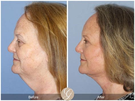 Neck Lift Before And After Photos Patient 18 Dr Kevin Sadati