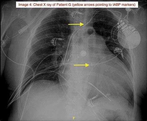 Unique Complications Associated With Patient Ambulation In The Setting