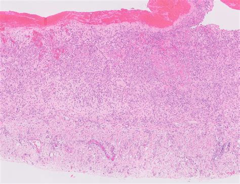 Pathology Outlines Mesothelioma Pleura Epithelioid