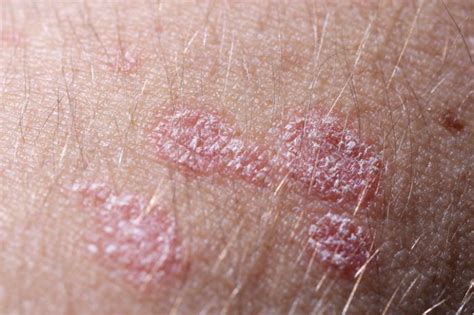 Ekzeme bilden sich häufig an talgdrüsenreichen körperstellen wie der kopfhaut. Psoríase: o tratamento com laser XTRAC pode ajudar ...