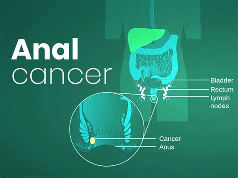 Anal Cancer Causes Symptoms Diagnosis And Treatment