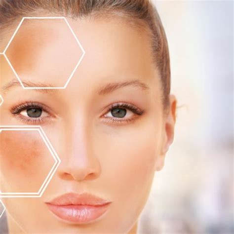 Láser Un Tratamiento Para El Melasma Mark Aesthetics Care