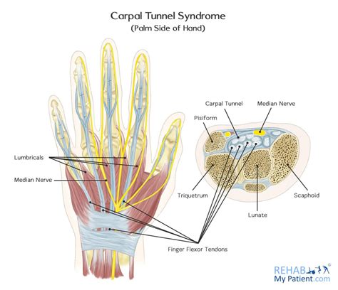 Carpal Tunnel Syndrome Rehab My Patient