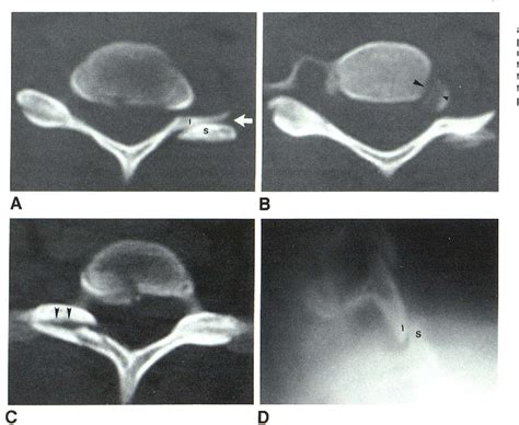 Figure 7 From Uncovertebral And Facet Joint Dislocations In Cervical