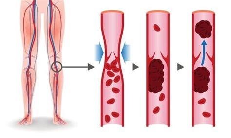 Deep Vein Thrombosis Dvt Causes And Treatments Orthopaedic