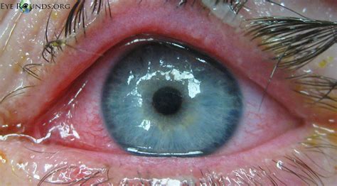 Ocular Manifestations Of Stevens Johnson Syndrome
