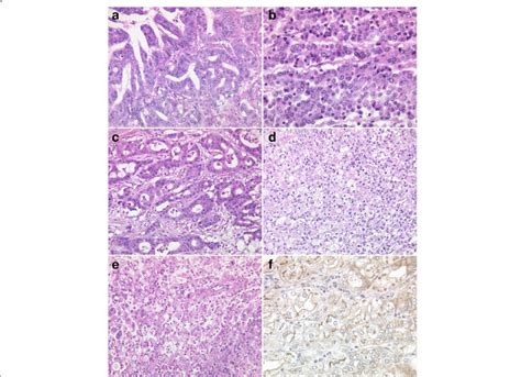 Histology Of Gastric Carcinomas With Gnas Mutations Patients No 36