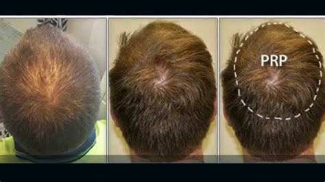 A person can shed 50 to 100 strands of hair a day and platelet rich plasma (prp) therapy is an innovative new treatment that can be used to treat many kinds of health issues. Hair Loss Problem? Why not consider PRP treatment
