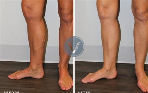 Treatment For Bulging Varicose Veins For 41yo Man The Vein Institute