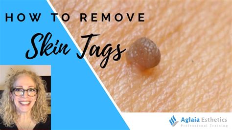 How To Remove Skin Tags Youtube