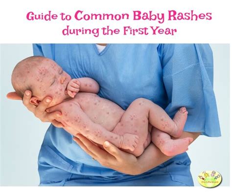 Common Baby Rashes During The First Year