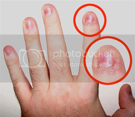 Fungal Skin Infection Between Fingers Candida Intestinala