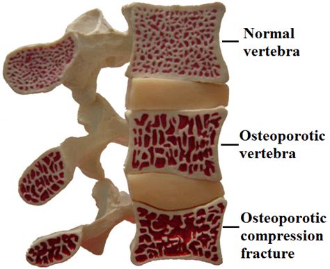Osteoporotic Fractures Clínica Neuros Neurocirujano Valencia