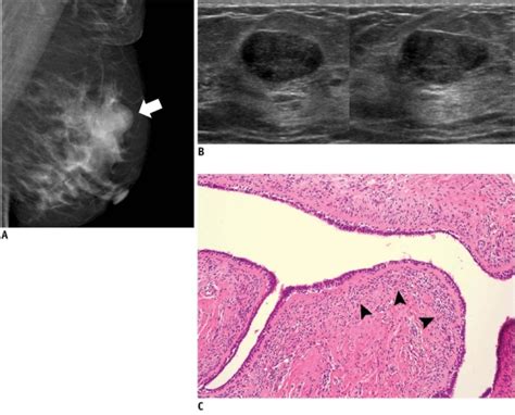 49 Year Old Woman With Palpable Mass In Her Left Breast A On