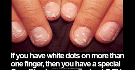 What Causes White Spots On Your Fingernails Design Talk