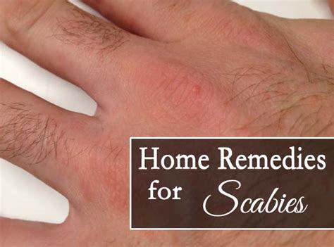 Top 10 Home Remedies For Scabies Starsricha