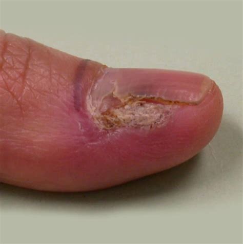 They may have tiny black or dark dots which are clotted blood vessels, and not the actual wart seed. Warts - Assurance Skin