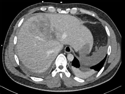 Repeated Ct Scan On Day 5 Showing Liver Laceration With No Evidence Of