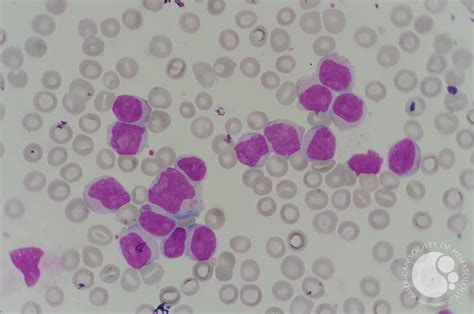 Chronic Lymphocytic Leukemia Cll With Presence Of Pro Lymphocytes 4