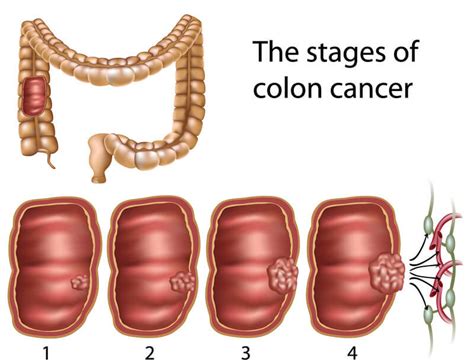 Colon cancer is a type of cancer that begins in the large intestine (colon). 7 Signs of Colon Cancer - Know What to Look For