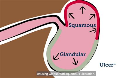 Equine Gastric Ulcer Animation Youtube
