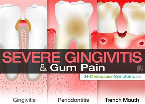 Severe Gingivitis And Gum Pain Menopause Now