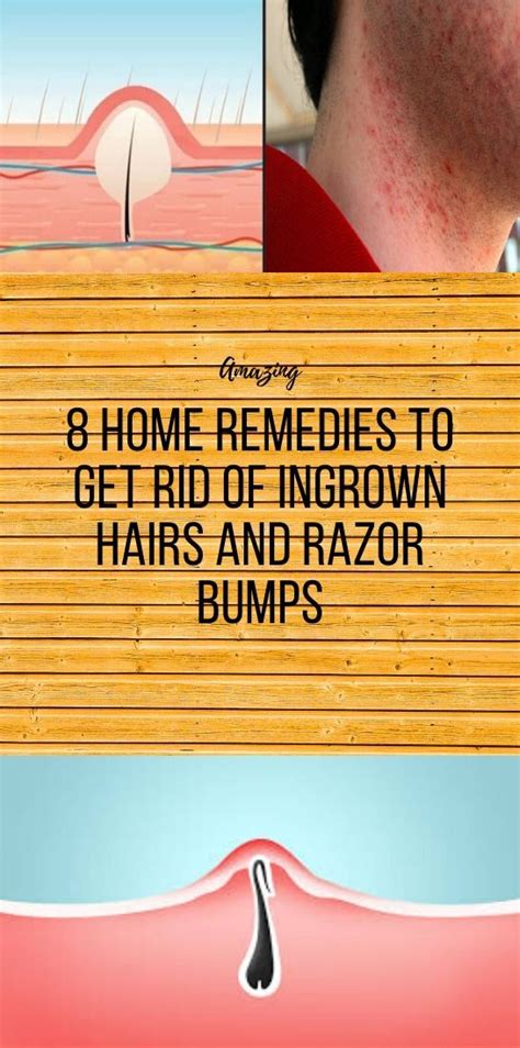 8 Home Remedies To Get Rid Of Ingrown Hairs And Razor Bumps In 2020