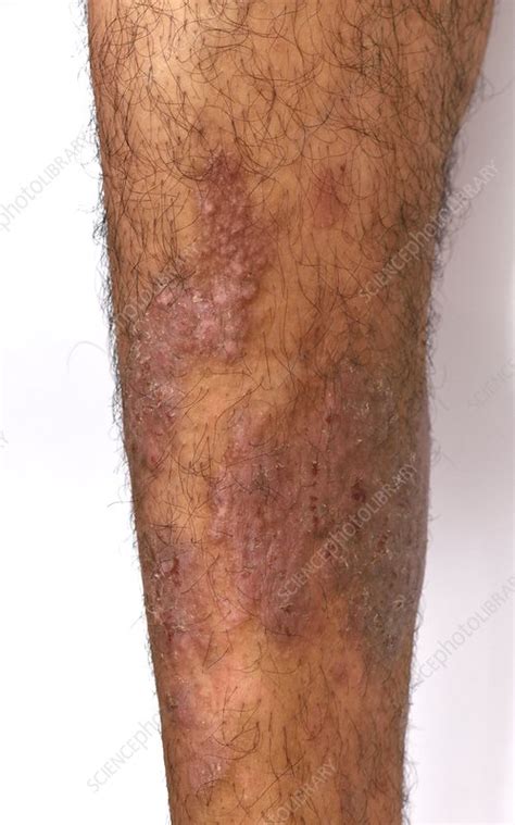 Psoriasiform Eczema Stock Image C0372202 Science Photo Library