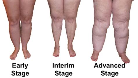 Lipedema Is A Medical Condition Often Confused With Lymphedema