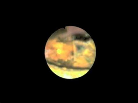 However, ct does not always visualize biliary stones and has limited sensitivity for determining intraductal tumor spread  10 . Biliary Endoscopy and Lithotripsy of Biliary Stones - YouTube