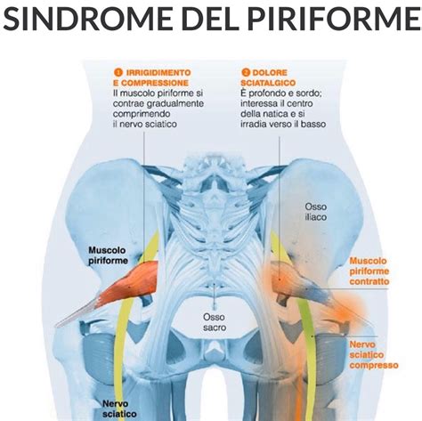 Sindrome Del Piriforme Cgm Fisioterapia