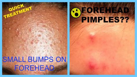 How To Cure Pimples On Forehead At Home Using Natural Products