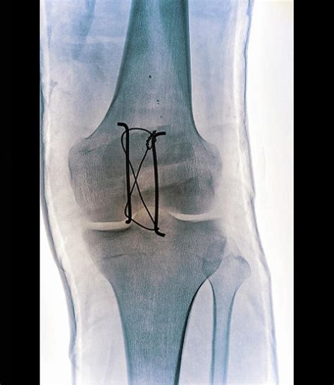 Pinned Kneecap Fracture Photograph By Zephyr Fine Art America