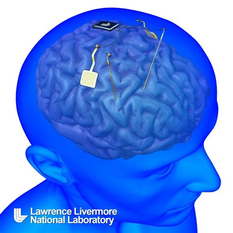 Hacking Brain Disorders Using Neural Implants Industry Tap