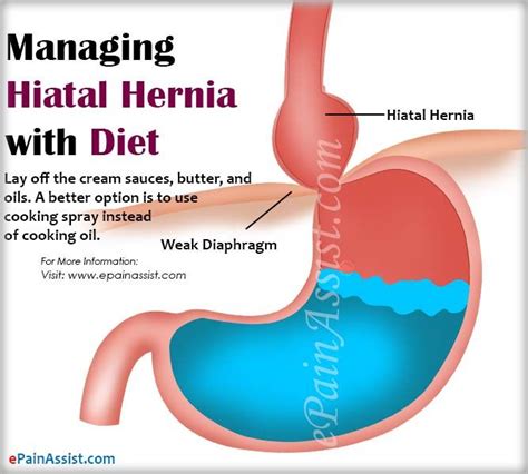 Managing Hiatal Hernia With Diet Lifestyle Changes Treatment Hiatal