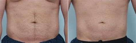 Coolsculpting Prep What To Do Before Your Treatment