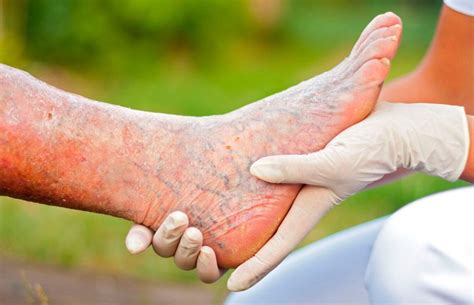 La trombosis venosa profunda, también llamada tvp, es un coágulo de sangre que se forma dentro de una vena en el cuerpo. Síntomas y diagnóstico de la trombosis venosa - I-Varices