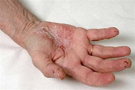 Dyshidrosis Causes Symptoms And Treatments