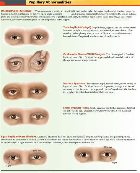 Manual Of Medicine On Twitter Pupillary Abnormalities