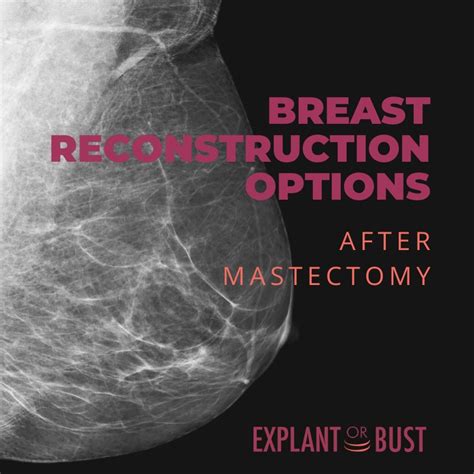 breast reconstruction options after mastectomy explant or bust