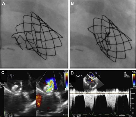 Melody Valve Fracture Causing Mitral Stenosis Novel Solution For