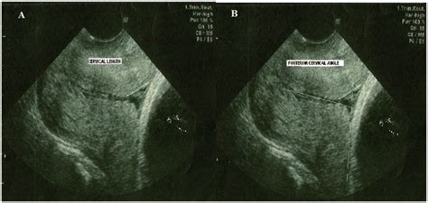 Transvaginal Ultrasound Images Of The Cervix Showing Cervical Length