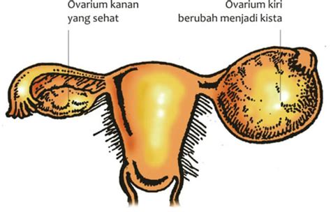 Kenali Jenis Kista Ovarium